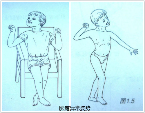 脑瘫儿童居家康复之（一）痉挛的处理(图1)
